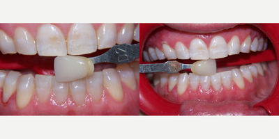 55-64 year old woman treated with Teeth Whitening, BriteSmile - In office teeth whitening