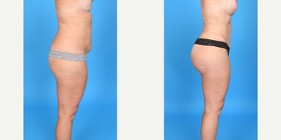 35-44 year old woman treated with Body Lift, Brazilian Butt Lift, Brazilian Butt Lift Revision, Butt Augmentation, Butt Lift, La - Before and after skinny BBL as part of a mommy makeover: Breast augmentation, tummy tuck, and BBL. We added 500cc pure fat to each butt to give a better shape and size. I call this a skinny BBL as the goal is always a perfect shape and not necessarily maximum volume.