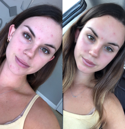 18-24 year old woman treated with HydraFacial - 18-24 year old woman treated with HydraFacial