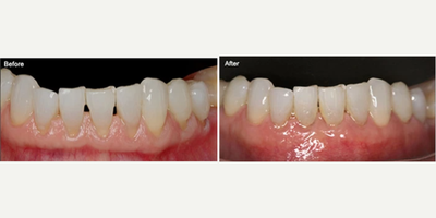 35-44 year old woman treated with Pinhole Gum Surgery - Patient had recession on the lower teeth. Pinhole Surgical Technique; a scalpel-free, suture-free breakthrough procedure to treat gum recession was done on this patient.