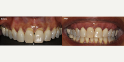 35-44 year old man treated with Pinhole Gum Surgery - Pinhole Surgical Technique; a scalpel-free, suture-free breakthrough procedure to treat gum recession. Since there are no incisions, patients can expect minimal post-operative symptoms such as pain, swelling and bleeding.