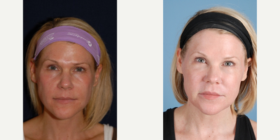 44 year old woman treated with Laser Resurfacing - 44 year old female who desired a smoother and less-red complexion. She underwent a Smartskin CO2 Laser and the Excel V for redness. As you can see her redness is gone and the results show more smooth color and texture of the skin. This will continue improving for months after the treatment. She does not need to avoid sun in the future but should protect herself from aging using sunscreen and anti-oxidant serums.