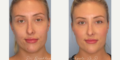 Woman treated with Chin Filler - Woman treated with Dermal Fillers using Voluma to cheeks, chin, and marionette lines as well as Volux to jawline and chin. Post-op, patient had a better defined jawline, restored volume in her cheeks, and balanced facial symmetry.