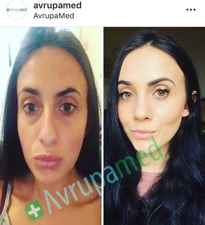 Rhinoplasty Istanbul Avrupamed Review Realself