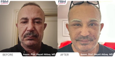 45-54 year old man treated with Deep Plane Facelift, Brow Lift, Facial Fat Transfer - 45-54 year old man treated with Deep Plane Facelift, Brow Lift, Facial Fat Transfer