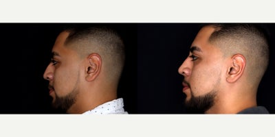 26 year old man treated with Nonsurgical Nose Job - 26 year old man treated with Nonsurgical Nose Job. Photos depict before and 1 month after 1 syringe of Restylane Lyft was injected to the nose (liquid rhinoplasty)