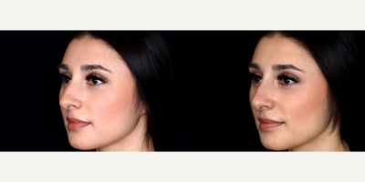 24 year old woman treated with Vollure, Nonsurgical Nose Job - 24 year old woman treated with 0.7 syringe of Vollure, Nonsurgical Nose Job. Photos depict before and immediately after treatment.