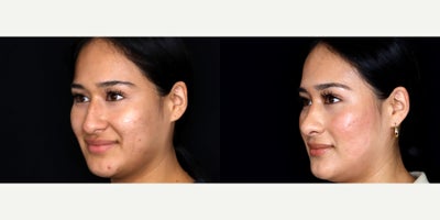 25 year old woman treated with Septoplasty, Rhinoplasty, Dermabrasion - 25 year old woman treated with Septoplasty, Rhinoplasty, Dermabrasion. Photos depict before and 2 months after surgery