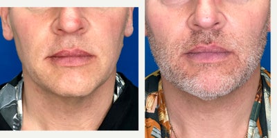 45-54 year old woman treated with Cheek Fillers, Chin Filler, Dermal Fillers, Contour Thread Lift, Miracu, Radiesse, RHA Collect - Volume loss and alteration in skin, muscle and fat are not limited to any age. Rejuvenation was performed using a combination of Endolift Laser to stimulate skin collagen and quality along with dissolving local fat in the face and neck. This was followed by PDO Threads, Miracu and Mint, to lift and support the skin. Weeks later the lost of volume was addressed with Radiesse and RHA fillers. Xeomin was added to soften the neck muscle bulges and wrinkles in the forehead.