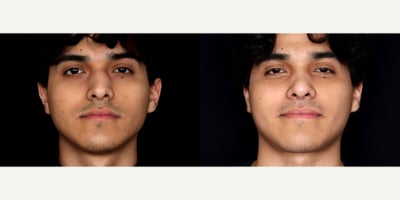 20 year old man treated with Septoplasty, Rhinoplasty - 20 year old man treated with Septoplasty, Rhinoplasty. Photos depict before and 3 months after surgery
