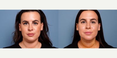 29 year old woman treated with myellevate - 29 year old woman treated with myellevate . Photos depict before and 1 week after surgery