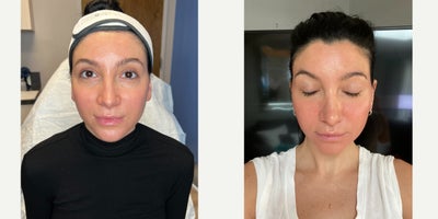 THE JOURNEY CONTINUES | ACNE SCAR COMBO - Our patient has been with us before, as she had some deeper acne scars which we continue to see improvement with as we progress in her acne scar journey. We did a stacked combination treatment consisting of TCA cross, Bellafill, Halo, and CO2- this time going more aggressive as she's had previous treatments with us. Immediately after, we applied Anteage Exosomes plus the EMER SKIN Illuminating Mask. These two are crucial steps after treatment as they aid in the healing process, help the skin peel, reduce redness, and leave the skin more rejuvenated than ever. Once she is healed, you can see the significant improvement in the texture of her skin and its radiance as well. No treatment is complete without EMER SKIN, especially acne scar treatments. Emer Skin is phenomenal for helping patients heal properly and expediently. Using our products post-treatment will also enhance results to the absolute maximum.EMER SKIN uses medical-grade ingredients that are essential for everyday skin health but also to reverse sun damage, pigmentation, uneven tone, and enlarged pores and redness.