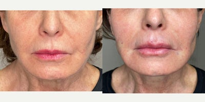 65-74 year old woman treated with Nonsurgical Facelift, Radiesse, RHA Collection Fillers, Skin Rejuvenation, Skin Tightening, Xe - Facial Rejuvenation in the hands of Dr. Jeffrey Rosenthal, requires a combination of procedures to stimulate collagen with the Endolift Laser, Lift and support sagging face, jaw and neck skin with PDO Threads (Miracu and Mint) and replace lost volume with Radiesse and RHA fillers. Harmony and Balance of the face and neck is the ideal rejuvenation.