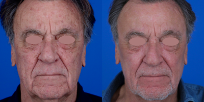 75 and up year old man treated with Chemical Peel, Laser Scar Removal, Scar Removal, Skin Rejuvenation, Laser Resurfacing, Skin  - We implemented a comprehensive combination therapy approach for a patient with an array of concerns, including multiple actinic keratosis, seborrheic keratosis, lentigines, age spots, hyperpigmentation, and skin laxity. Photos show the stunning transformation in just 3 months' time.