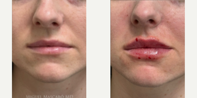Woman treated with Lip Fillers - Woman treated with Lip Fillers
