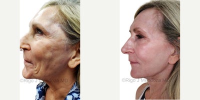 55-64 year old woman treated with Facelift, Neck Lift, Renuvion for Facial Resurfacing, Radiesse - This patient complaints included lax skin and loss of volume. To address her facial rejuvenation, she had the following procedures and treatments: Face Lift Neck Lift Facial Renewal Skin Resurfacing with Renuvion J Plasma of her face, eyes, neck and decollete. Radiesse dermal filler to her jawline to give her definition as well as correct asymmetry in the front of her jaw Radiesse dermal filler to her chin to increase loss of volume Hyper-diluted Radiesse to her perioral and cheeks to increase loss of volume and stimulate collagen Xeomin in her forehead, crow's feet and glabellar Skincare routine including ZO Skin Health and SkinCeutical products