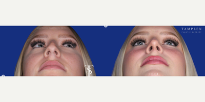 Woman treated with Rhinoplasty - All smiles!!! This lovely patient is just 6 weeks after open Rhinoplasty with my signature Tip Technique and she could not be happier!This one procedure has her entire face glowing! By supporting her nasal tip, she now has a beautiful profile that doesn't drop when she smiles and will last a lifetime.Her tip is refined and not pinched for an elegant & natural result.