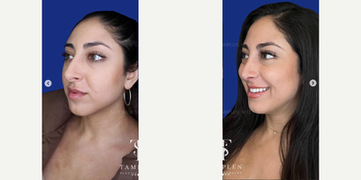 Woman treated with Revision Rhinoplasty - Just 6 weeks after Revision Rhinoplasty and this patient is feeling and breathing so much better!She had her first rhinoplasty by another surgeon and all though he made her nose smaller, without a straight foundation, this lead to severe deviation and nasal obstruction, valve collapse and a hanging columella.My Revision Rhinoplasty with my signature tip support technique was able to correct all of her issues - and now, she could not be happier with her nose and says this is the nose Ive always wanted.Elegant, natural and open airways. This is what its all about!