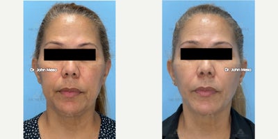 55-64 year old woman treated with Buccal Fat Removal, Extended Chin Liposuction, NeckTite, Mini FaceTite, Morpheus8 - 55-64 year old woman treated with Buccal Fat Removal, Extended Chin Liposuction, NeckTite, Mini FaceTite, Morpheus8