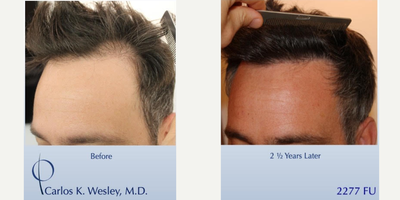#BAM Most Natural Hairline (2277 FUE and FUT grafts): Carlos K. Wesley, M.D. (NYC&LA) - In order to repair a poorly-executed transplant performed by another surgeon, this 39-year-old man underwent a session combining follicular unit extraction (FUE) with follicular unit transplantation (FUT) with Dr. Carlos K. Wesley in which a total of 2277 grafts were placedAspects of our surgical approach can be viewed on our sites Most Common Questions page. Three unique elements combined to help improve his experience: no-shave requirement for optimal discretion, enhanced graft storage measures, and rigid patient safety standards.As with all of Dr. Wesleys patients, he was NOT required to cut his hair for the procedure. As a result, this patient was able to return comfortably to work and social activities within approximately 7-10 days of his procedure.The patients hair follicles were incubated in platelet rich plasma (PRP) throughout the duration of the procedure. This, combined with an ATP-containing storage solution has been shown to enhance survival of transplanted hairs.The patient returned 2.5 years after his procedure and images of the patient can be seen below.
