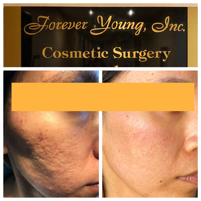 35-44 year old woman treated with Bellafill, MiXto Laser, Laser Resurfacing, CO2 Laser, Sculptra - Mixto fractional CO2 resurfacing was combined with subcision and Sculptra Filler and Bellafill to treat deep atrophic and rolling acne scars. Two treatments were performed, six months apart, and this is the patient one year after the first treatment.