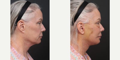 68-70 year old woman treated with Facelift Revision, Neck Lift Revision, Eyelid Surgery Revision, Facial Fat Transfer - Facelift RevisionNeck Lift RevisionLower Blepharoplasty RevisionFacial Fat Transfer