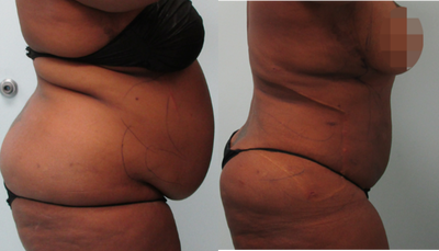 Lipo Only With Results Like A Tummy Tuck! - liposuction, tiny pinpoint scars, minimal 3 day downtime, easy recovery. by&nbsp;Dr. Gruber&nbsp;