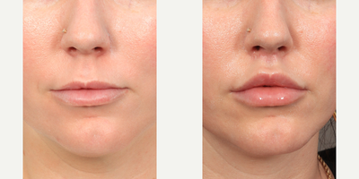 Dr. Lexie Wang performed an upper Lip Lift with a corner lip lift. - Dr. Lexie Wang performed an upper Lip Lift with a corner lip lift. This was performed under local anesthesia, the patient was awake. These results are 3 months post-op.
