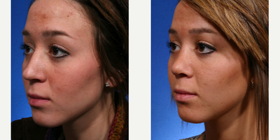 Woman treated with Revision Rhinoplasty - Woman treated with Revision Rhinoplasty