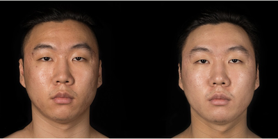 18-24 year old man treated with Cosmelan - This is a man in his 20's one month post op after Cosmelan