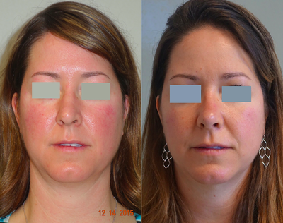 Chin Liposuction - Chin Liposuction