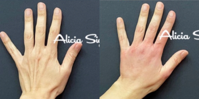 45-54 year old woman treated with Hand Rejuvenation - Patient felt her hands didnt fit her age and energy level