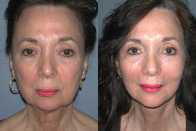 Chin Surgery on 65-year-old - 
	This 65-year-old woman had a Chin Augmentation, Browlift, Facelift and Cheek Implants.
