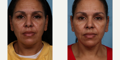 45-54 year old woman treated with Smart Lipo, PrecisionTx, Chin Liposuction, Mini Facelift, Nonsurgical Neck Lift - Our 54 year old patient came in today for her 3 month post operative visit after her Precision Tx. Laser Lift.  Her goal was to tighten her neck and jaw line without having to undergo major surgery given her busy work schedule.  Patients who are open to more subtle results and not ready for a deep plane facelift will benefit the most from Laser Lifts given that they still have good collagen health as this procedure requires the patient to produce new elastic collagen for optimal results.  Downtime is only 2 to 3 days and results can last 3 to 5 years.  This is a great bridging procedure until they finally decide its time for their Deep Plane Facelift.