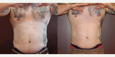 UltraSlim - Man treated with UltraSlim