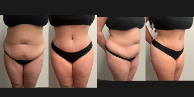 25-34 year old woman treated with Tummy Tuck, Butt Augmentation - Extended abdominoplasty with fat transfer to hip dips for overall hourglass shape goals.