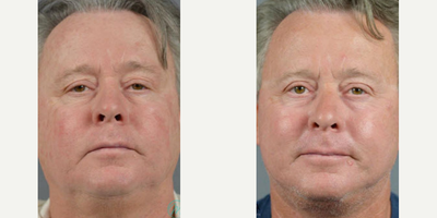 Man treated with Facelift, ActiveFX - In a recent blog post, we explored popular cosmetic surgery procedures for men. We learned that every year, thousands of men across the country undergo procedures to enhance their appearance, boost self-confidence and recapture youth. Men are also taking control of their aging processDr. James Marotta
