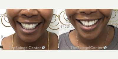 Woman treated with Dimple Surgery - Woman treated with Dimple Surgery