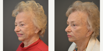 75 and up year old woman treated with Facelift - This 78 yo had a Revision High SMAS Face and Neck