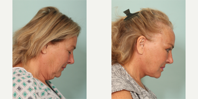 55-64 year old woman treated with Lower Facelift, Neck Lift - performed by Dr. Sozer