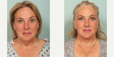 55-64 year old woman treated with Lower Facelift, Neck Lift - performed by Dr. Sozer