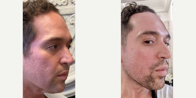 35-44 year old man treated with Bellafill, CO2 Laser, Subcision, Microneedling RF - Our patient's confidence has been hindered due to his acne scars. So, after seeing the results we're able to achieve when it comes to acne scars, he came to us for some help. For him, we did one of our famous acne scar combos consisting of: Bellafill to fill in and plump his deeper scars, Subcision to go under the skin and break up his scars, Pixel8 MNRF to improve textural irregularities, and our CO2 resurfacing laser to reduce his scars. With this roster, we set him up for success but we always go the extra mile- this time immediately after treatment we applied PRP + gave him an oxygen facial under our red light to expedite his healing. As this was his first treatment with us, we were able to see a significant improvement with his scars but to completely reduce them he will be coming back for another round of treatment. He is very excited with how smooth his skin looks, and constantly gets asked what his secret is for smooth skin. It's no secret- we are the best in the game!