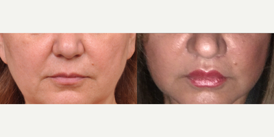 45-54 year old woman treated with Lip Lift - Patient desired more full lips without needing filler and more upper tooth show.