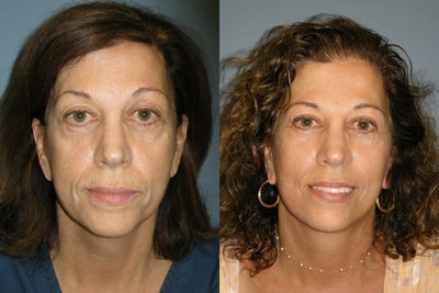 Lite-lift - 
	Like many other advertised modified facelifts, the Lite-lift is a procedure that reduces signs of aging of the lower face, jawbone, and neck. Patients looking for affordable and quick facial rejuvenation should take a serious look at our Lite-lift.
