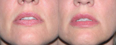Injectables  - Evolence to lips, Nasolabial folds, Melolabial fold