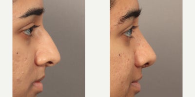 18-24 year old woman treated with Rhinoplasty with an Alarplasty (Nostril Reduction) - Dr. Lexie Wang performed a Rhinoplasty with an Alarplasty (Nostril Reduction). The patient is 4 months post-op.