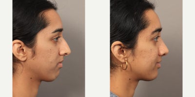 18-24 year old woman treated with Rhinoplasty with an Alarplasty (Nostril Reduction) - Dr. Lexie Wang performed a Rhinoplasty with an Alarplasty (Nostril Reduction). The patient is 4 months post-op.