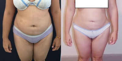 25-34 year old woman treated with Brazilian Butt Lift - Great post op results in this 29 year old patient from New York two months after surgery with Premium Care. She is looking great after a bra line back lift, 360 liposuction, and Brazilian butt lift. Surgical time was four hours using two plastic surgeons, and she spent 10 days recovering in Cartagena at our five star Recovery Suites. Her figure looks beautiful and she is enjoying the confidence that comes with looking great.