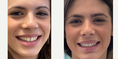 Woman treated with Smile Makeover - Invisalign Before and after
