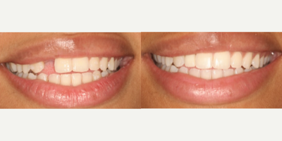 Patient treated with Dental Crown, Porcelain Veneers - What a beautiful implant transformation! Can you believe how natural it looks?